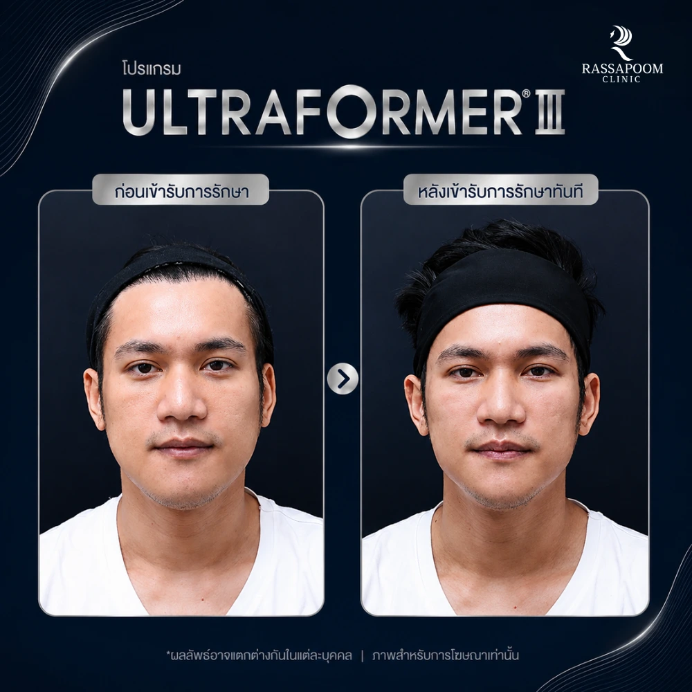 ผลลัพธ์หลังทำ โปรแกรม Ultraformer III