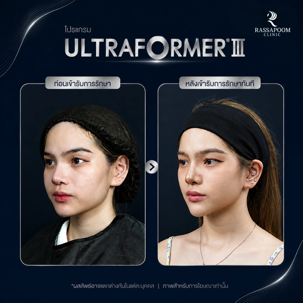 ผลลัพธ์หลังทำ โปรแกรม Ultraformer III