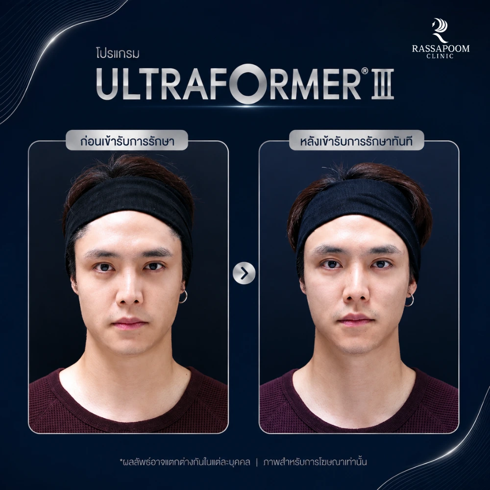 ผลลัพธ์หลังทำ โปรแกรม Ultraformer III