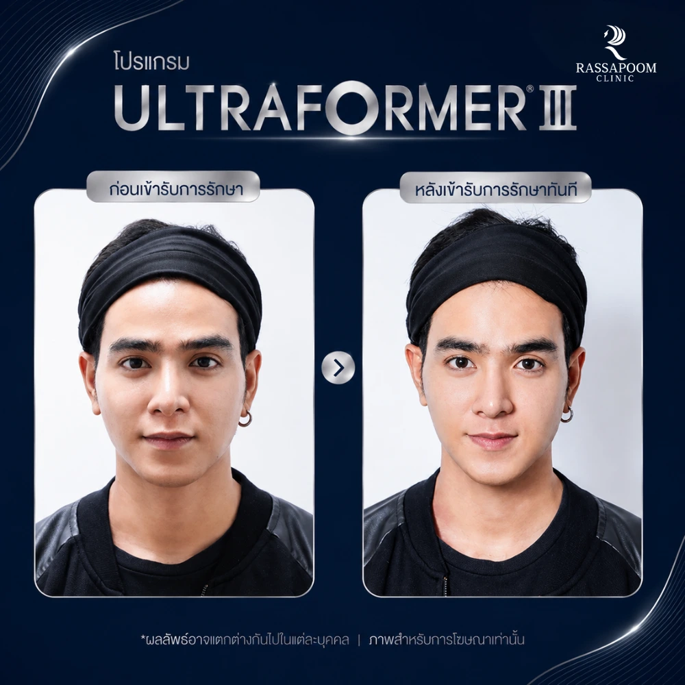 ผลลัพธ์หลังทำ โปรแกรม Ultraformer III