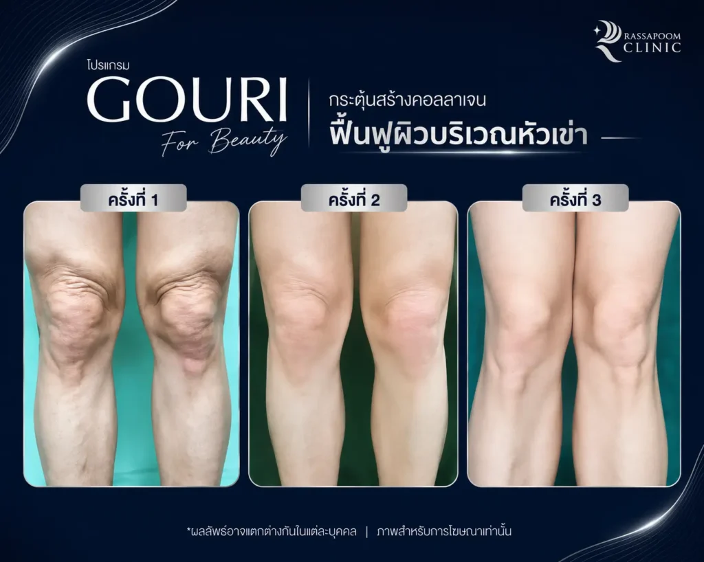 รวมผลลัพธ์หลังทำโปรแกรม Gouri (1)