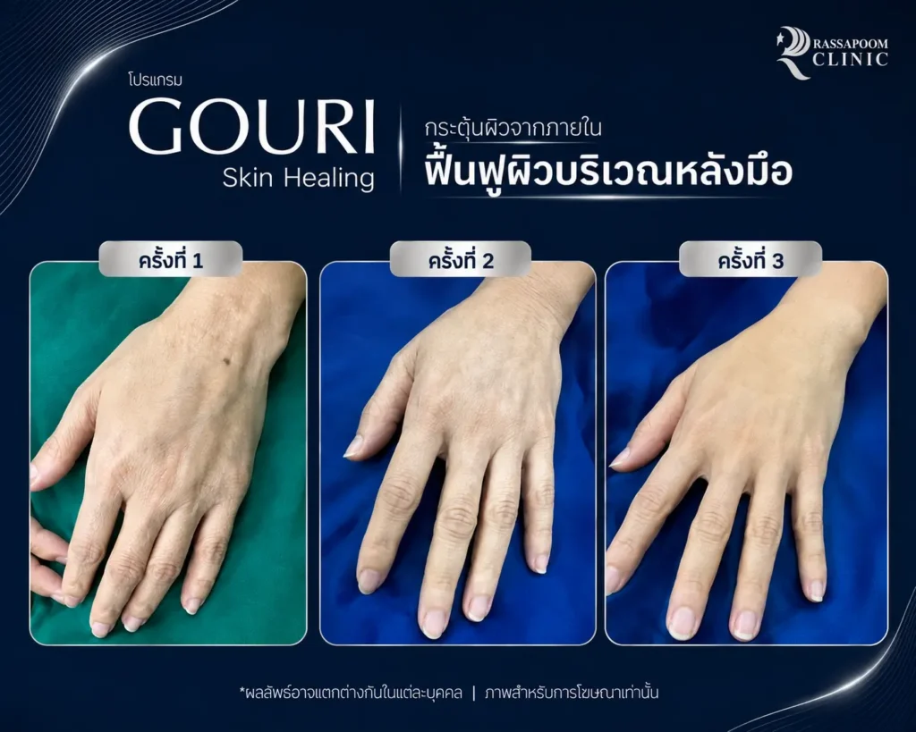 รวมผลลัพธ์หลังทำโปรแกรม Gouri (2)