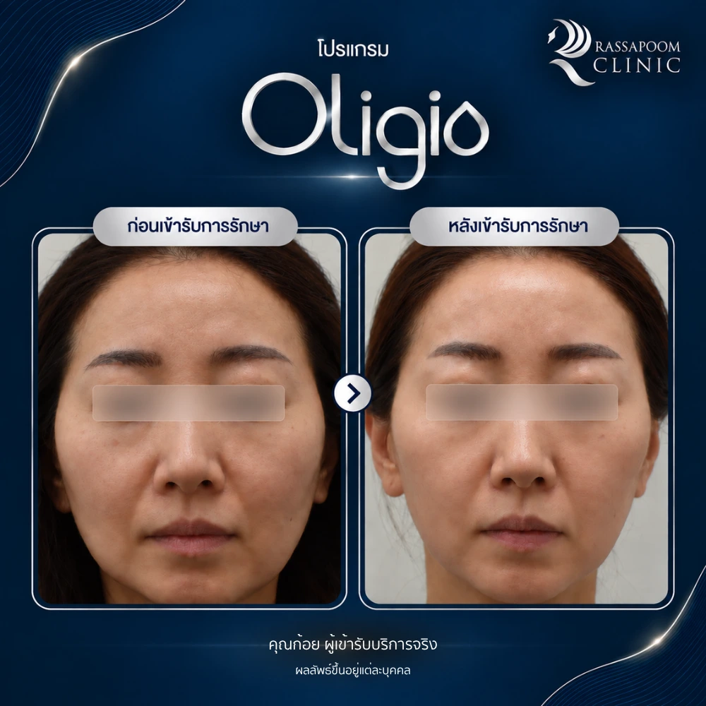 รีวิวโปรแกรม Oligio