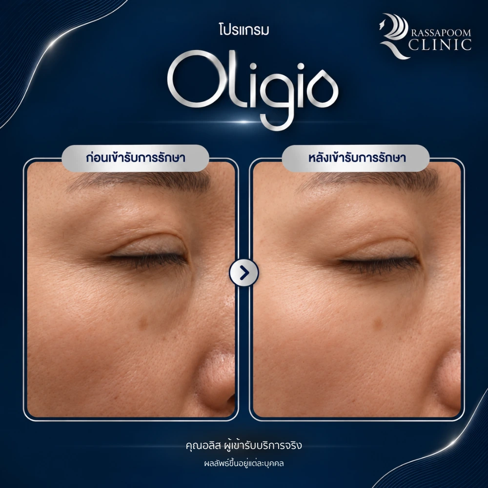 รีวิวโปรแกรม Oligio