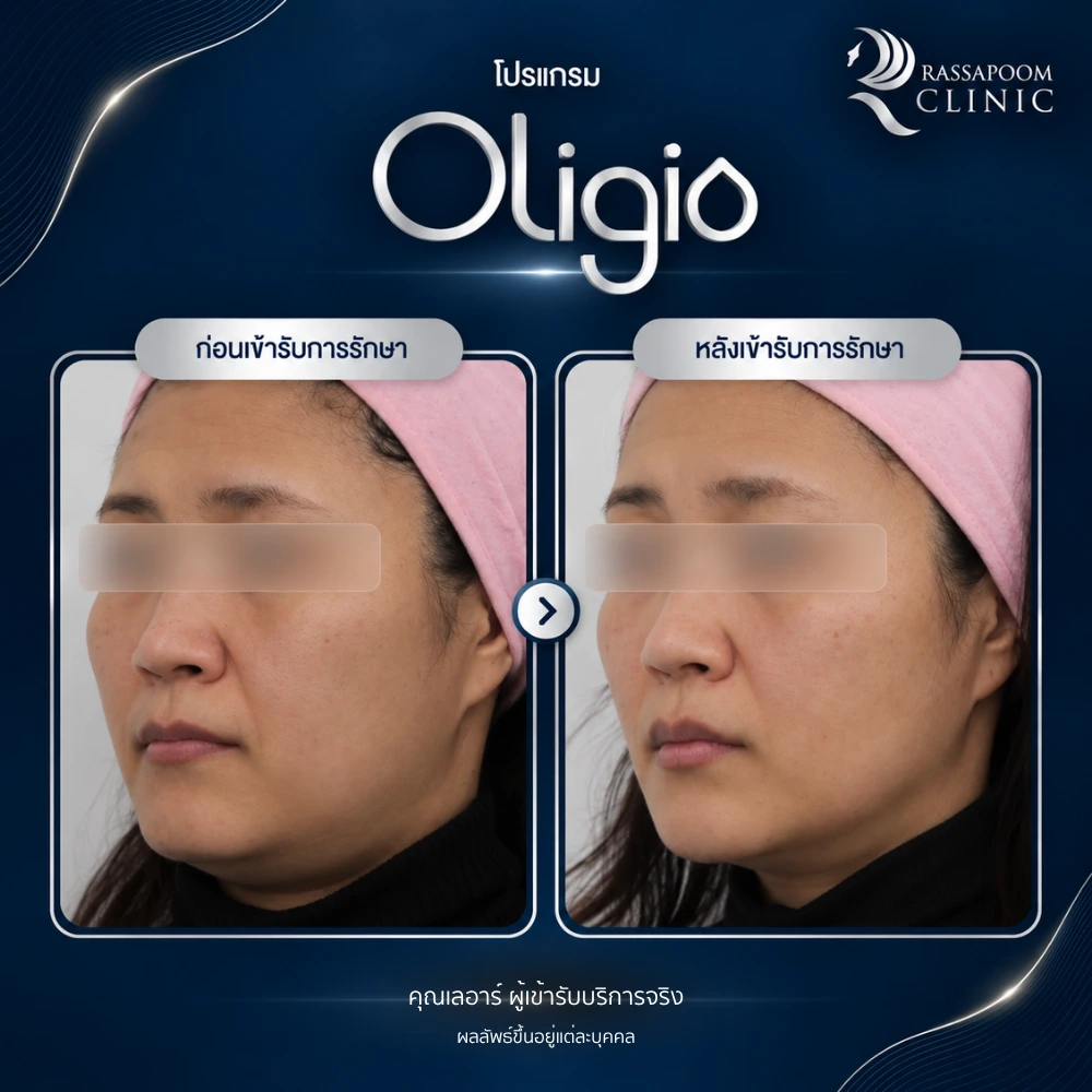 รีวิวโปรแกรม Oligio