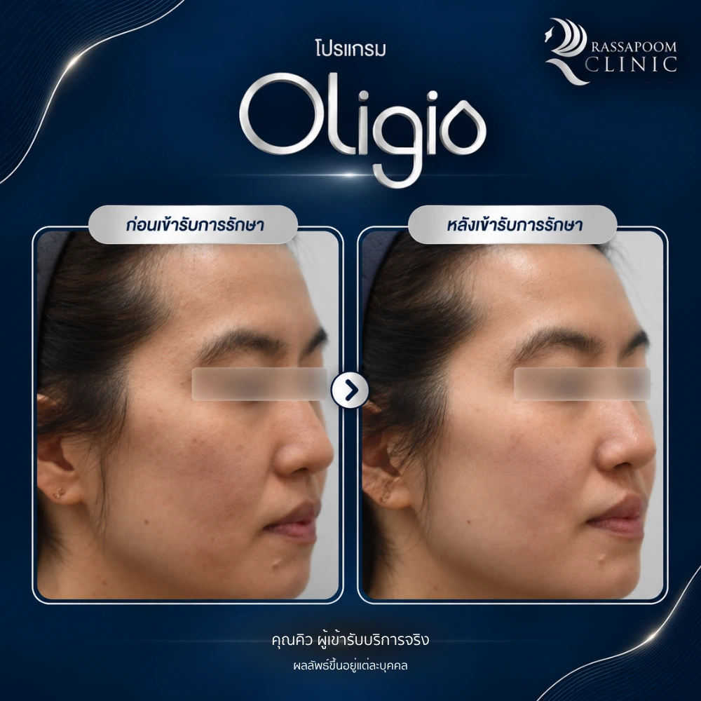 รีวิวโปรแกรม Oligio