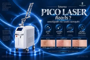 โปรแกรม Pico Laser คืออะไร เลเซอร์ดูแลฝ้า กระ รอยสิว และหลุมสิว