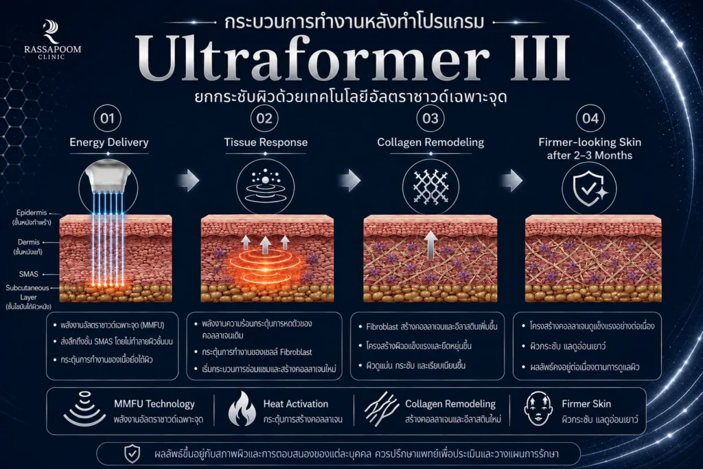 โปรแกรม Ultraformer III ทำงานอย่างไร