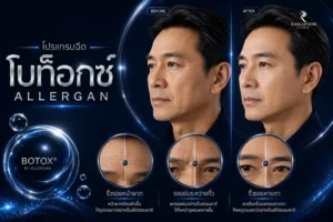 โปรแกรมฉีดโบท็อกซ์ Allergan ตัวช่วยดูแลริ้วรอยและปรับสัดส่วนใบหน้า